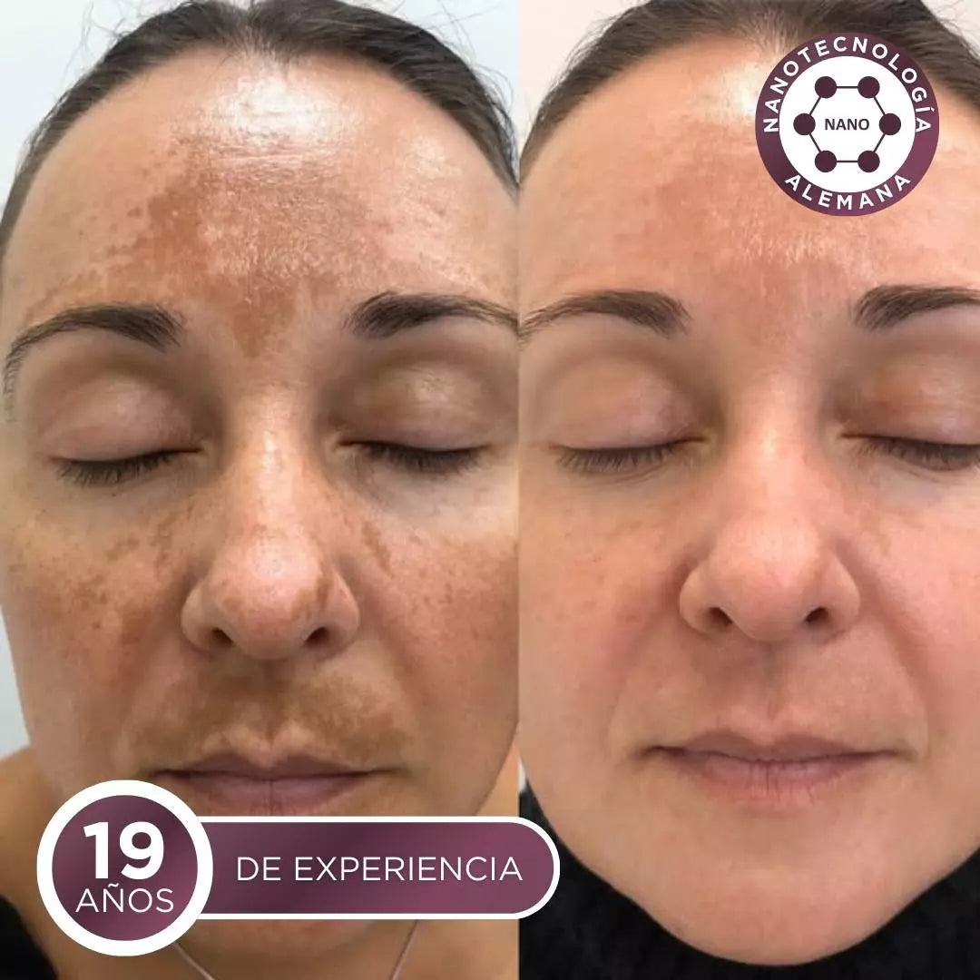 Kit Acné, Détox, Cicatrices, Poros Dilatados (BL1 Beauclean + BL2)