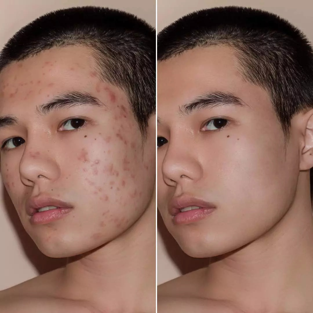 Kit Acné, Détox, Cicatrices, Poros Dilatados (BL1 Beauclean + BL2)