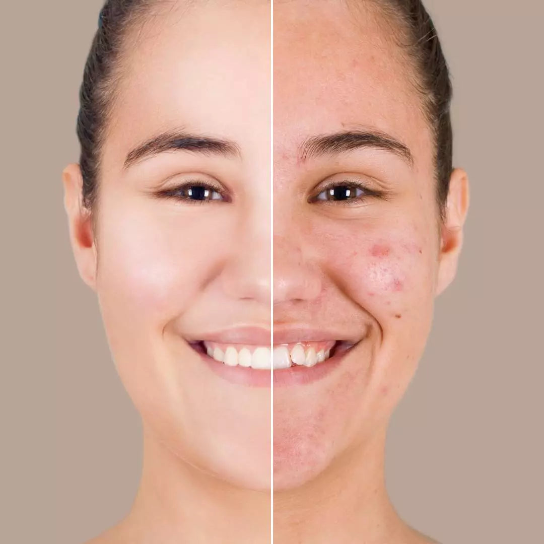 Kit Acné, Détox, Cicatrices, Poros Dilatados (BL1 Beauclean + BL2)