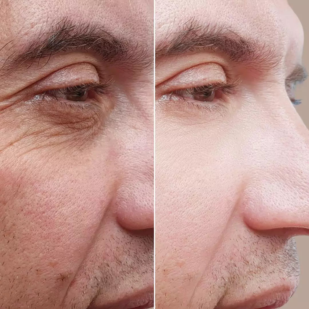 Kit Acné, Détox, Cicatrices, Poros Dilatados (BL1 Beauclean + BL2)